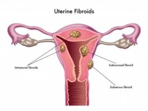 Miomas uterinos y fertilidad