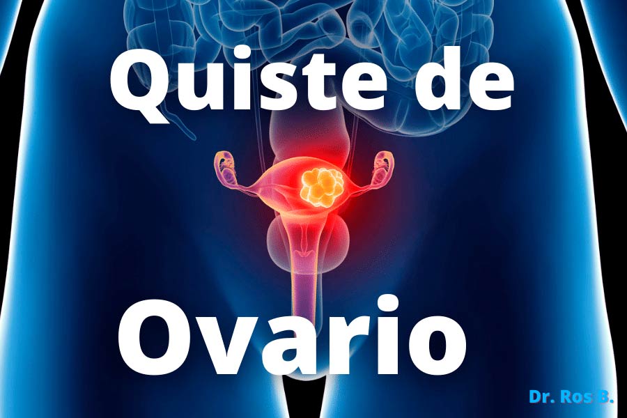 Ultrasonido y valoración de riesgo de cáncer de ovario -