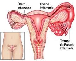 inflamación del endometrio