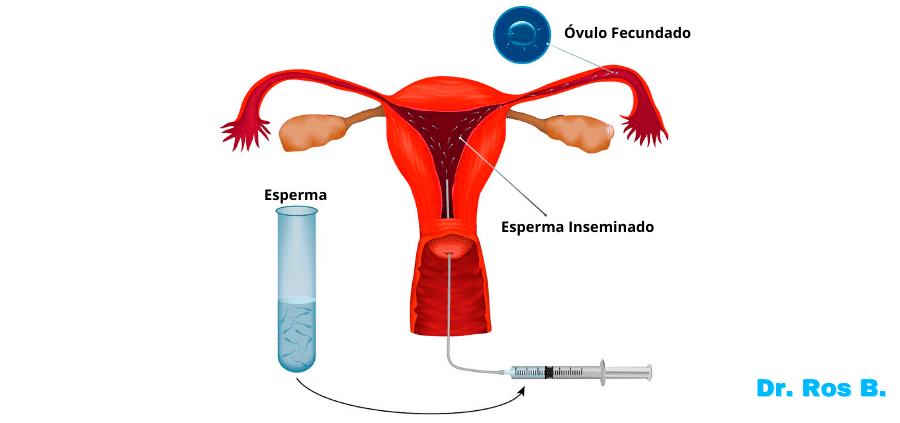 proceso de una inseminacion artificial